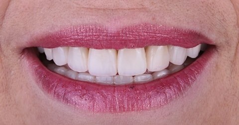 Resultado frontal de carillas dentales